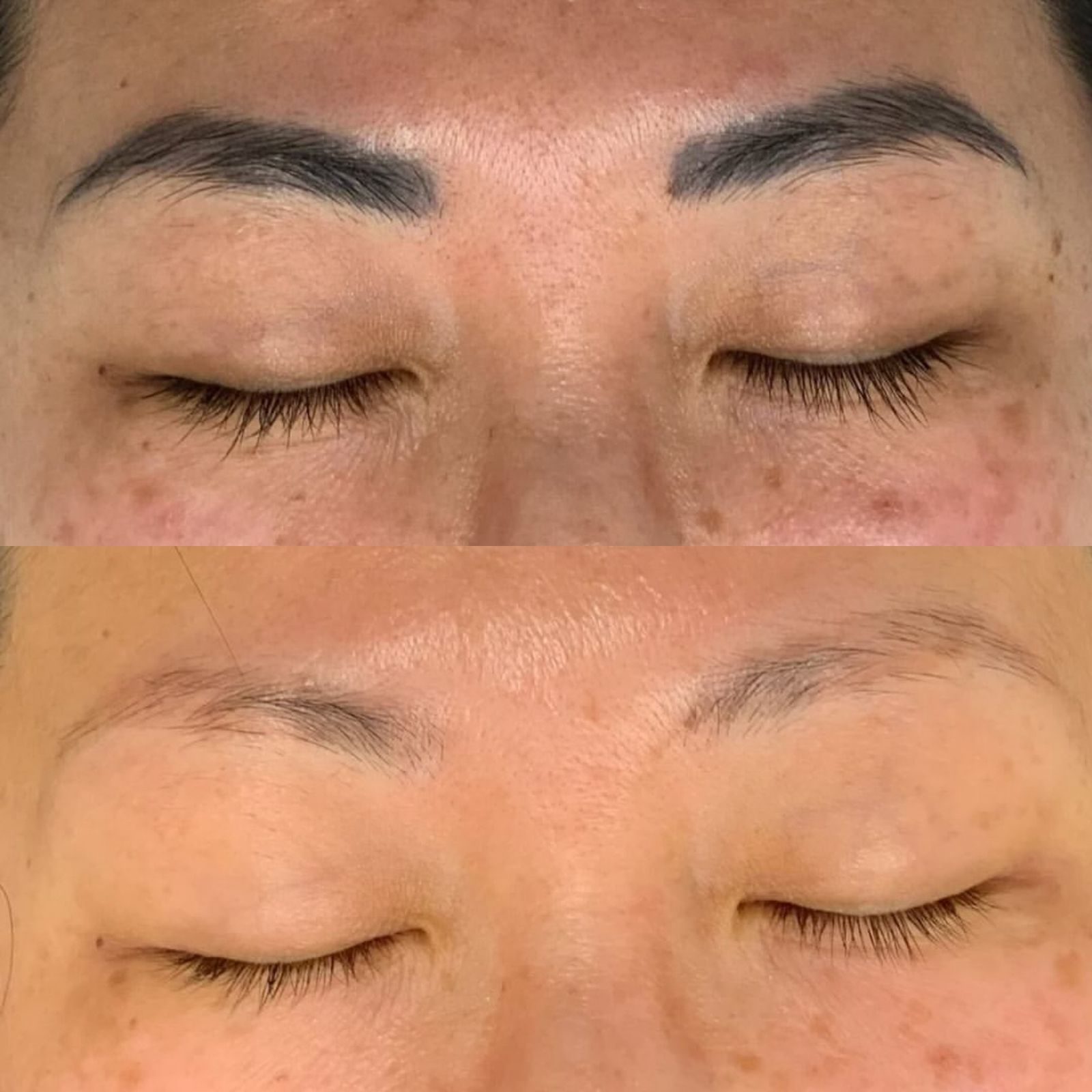 Resultado de remoção a laser